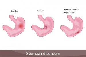 Peptic Ulcer - Health Facts